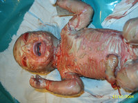 Click image for larger version

Name:	Harlequin Ichthyosis[1].jpg
Views:	72
Size:	481.0 KB
ID:	973638